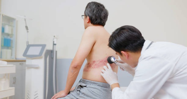 대상포진 병원 방문