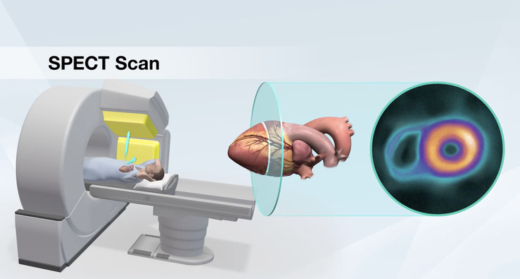 SPECT Scan