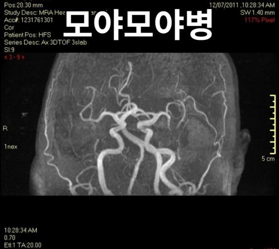 모야모야병 초기 증상 7가지, 자가진단 가능할까?