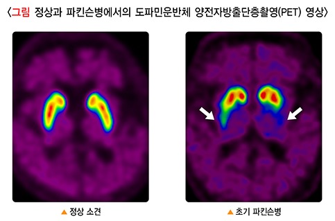 정상과 파킨슨병에서의 도파민운반체 양전자방출단층촬영(PET) 영상