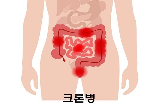 크론병 증상을 빠르게 파악하는 5가지 체크리스트