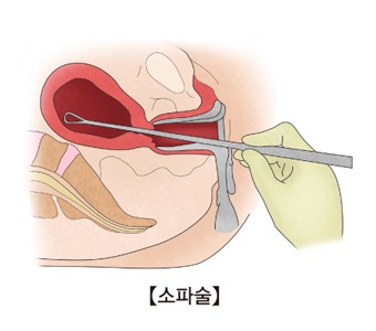 계류유산 소파술, 꼭 해야 할까? (수술 과정, 비용, 후유증의 모든 것)