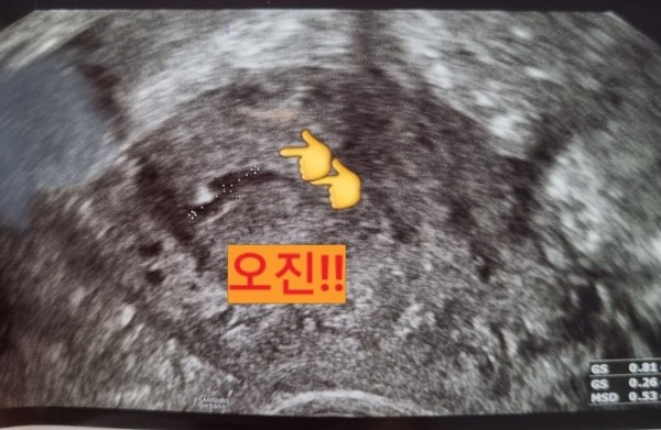 계류유산 오진 가능성, 혹시 우리 아기는 괜찮지 않을까요?