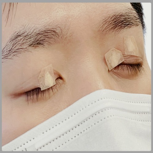 비립종 집에서 제거? 절대 금물! 위험한 이유와 안전한 방법